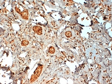 Immunohistochemistry: Formalin-fixed and paraffin-embedded Human breast cancer biopsy stained with ARG22851 anti-Estrogen Receptor beta antibody [57/3]. Antigen Retrieval: Boil tissue section in Citrate buffer (pH 6.2). (Low power).