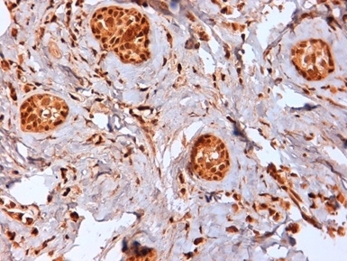 Immunohistochemistry: Formalin-fixed and paraffin-embedded Human breast cancer biopsy stained with ARG22851 anti-Estrogen Receptor beta antibody [57/3]. Antigen Retrieval: Boil tissue section in Citrate buffer (pH 6.2). (High power).