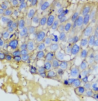 Immunohistochemistry: Paraffin-embedded Human lung cancer tissue stained with ARG41401 anti-EpCAM antibody at 1:100 dilution.